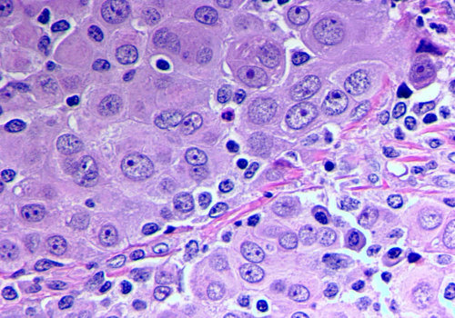 Understanding the Different Types of Mesothelioma